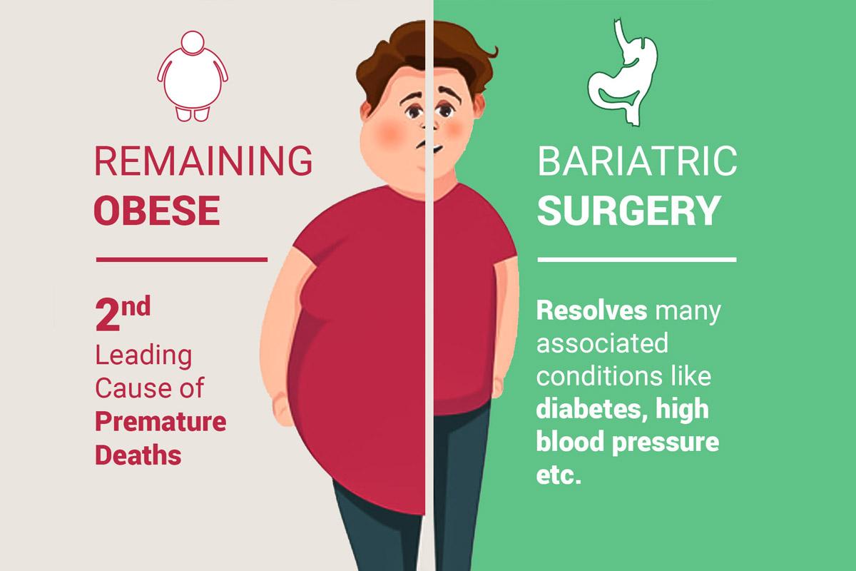 Obesity vs. Bariatric